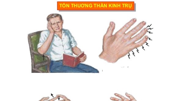 Tổn thương thần kinh trụ